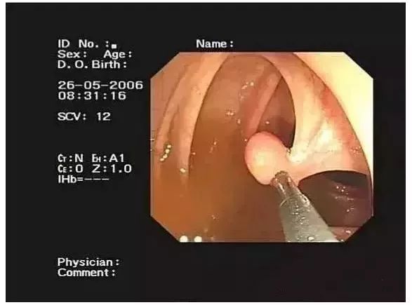 胃肠息肉手术多少钱,胃肠息肉的症状表现