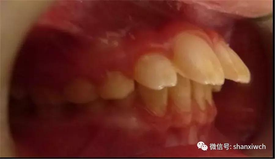 育儿知识关于牙齿,育儿知识幼儿牙齿敏感期