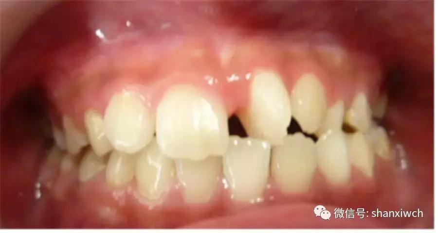 育儿知识关于牙齿,育儿知识幼儿牙齿敏感期