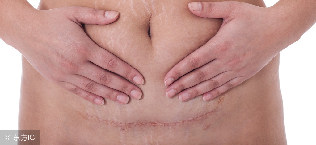 剖腹产肚子上的蚯蚓怎么去除,剖腹产小蚯蚓怎么弄