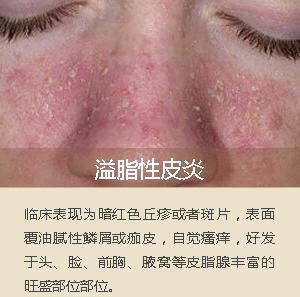 面部脂溢性皮炎辨别图片,面部脂溢性皮炎怎么治