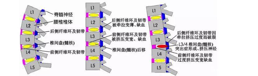 腰椎间盘突出最难康复的10种方法,腰椎间盘突出别担心90%都能恢复