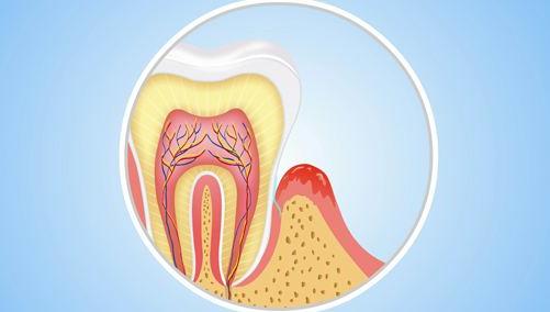 牙龈萎缩露出牙根还能恢复吗,牙龈萎缩牙齿根部会疼吗