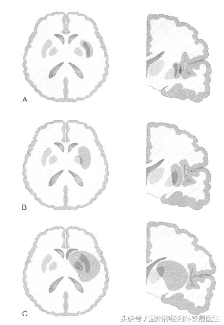 脑出血李医生,脑出血病例分析及答案
