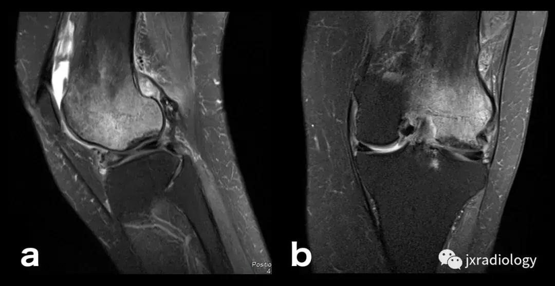 膝关节骨髓水肿疼痛特点,膝关节骨髓水肿的临床表现