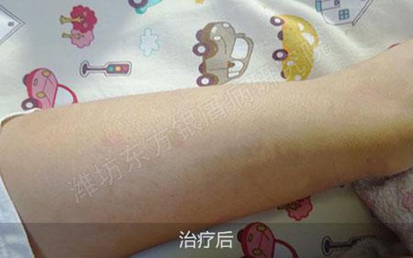 治疗牛皮癣全国最佳医院,2020年国家根治牛皮癣特效药