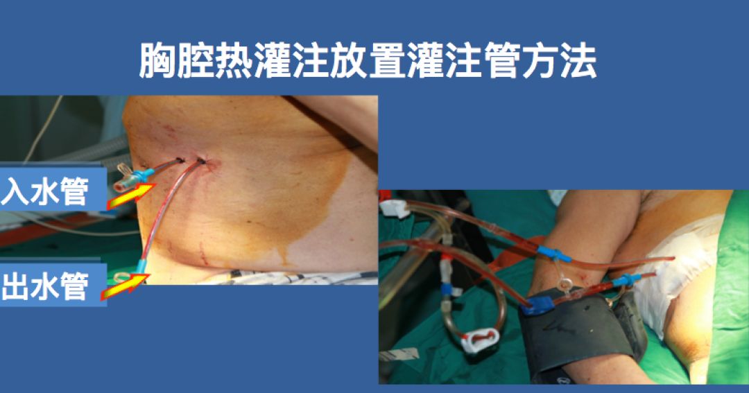 胸腔洗个“热水澡”,恶性胸水全没了