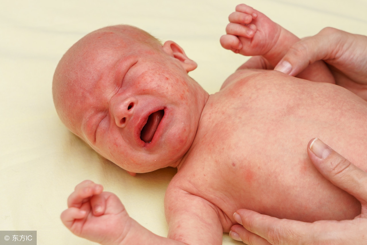 宝宝身上起湿疹宝妈可以吃羊肉吗,宝宝脸上有湿疹宝妈可以吃皮蛋吗