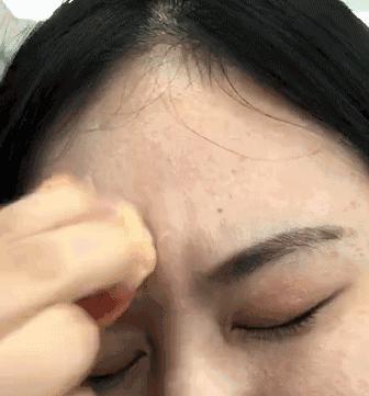 青少年痘印怎么消除小妙招,如何消除痘印祛痘