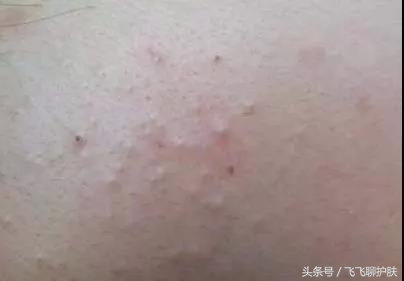 各种痘痘的类型及治疗方法,四种常见的痘痘类型应该如何区分