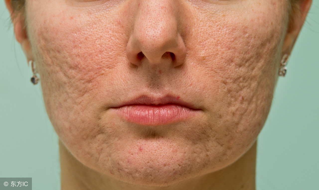 解决毛孔粗大这三招就够了,解决毛孔粗大的方法你学会了吗