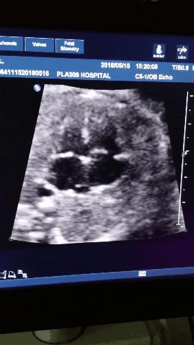 孕期B超数据准确吗,b超医生说的数字