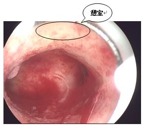 剖宫产引起的例假淋漓不尽怎么办,妇科剖腹产术后月经不干净