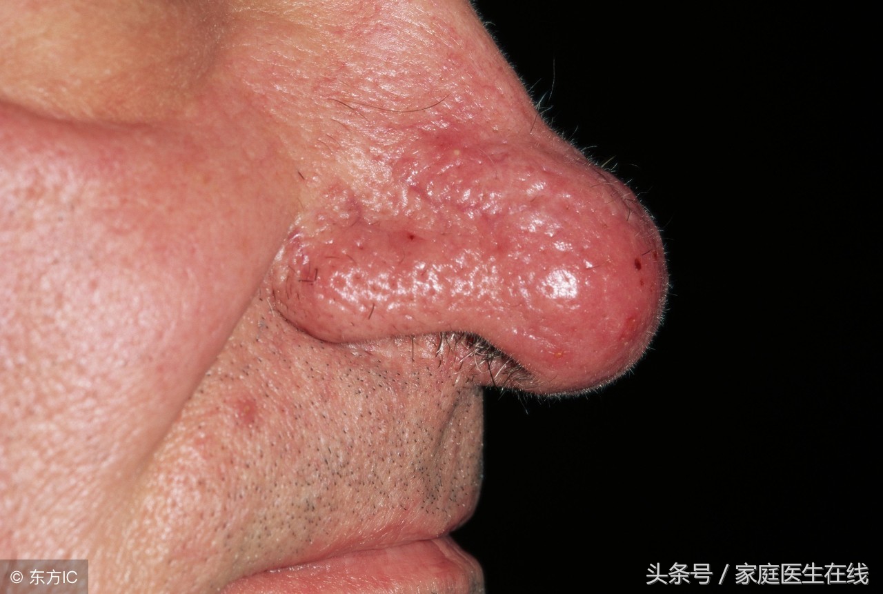 如何才能有效治疗酒糟鼻痤疮,怎么处理酒糟鼻和痤疮