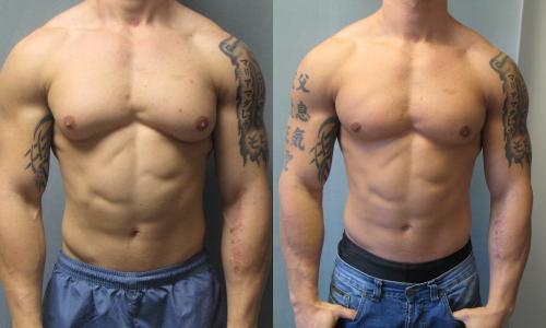 男性左乳房发育是什么原因引起的,男人胸部太大有问题吗