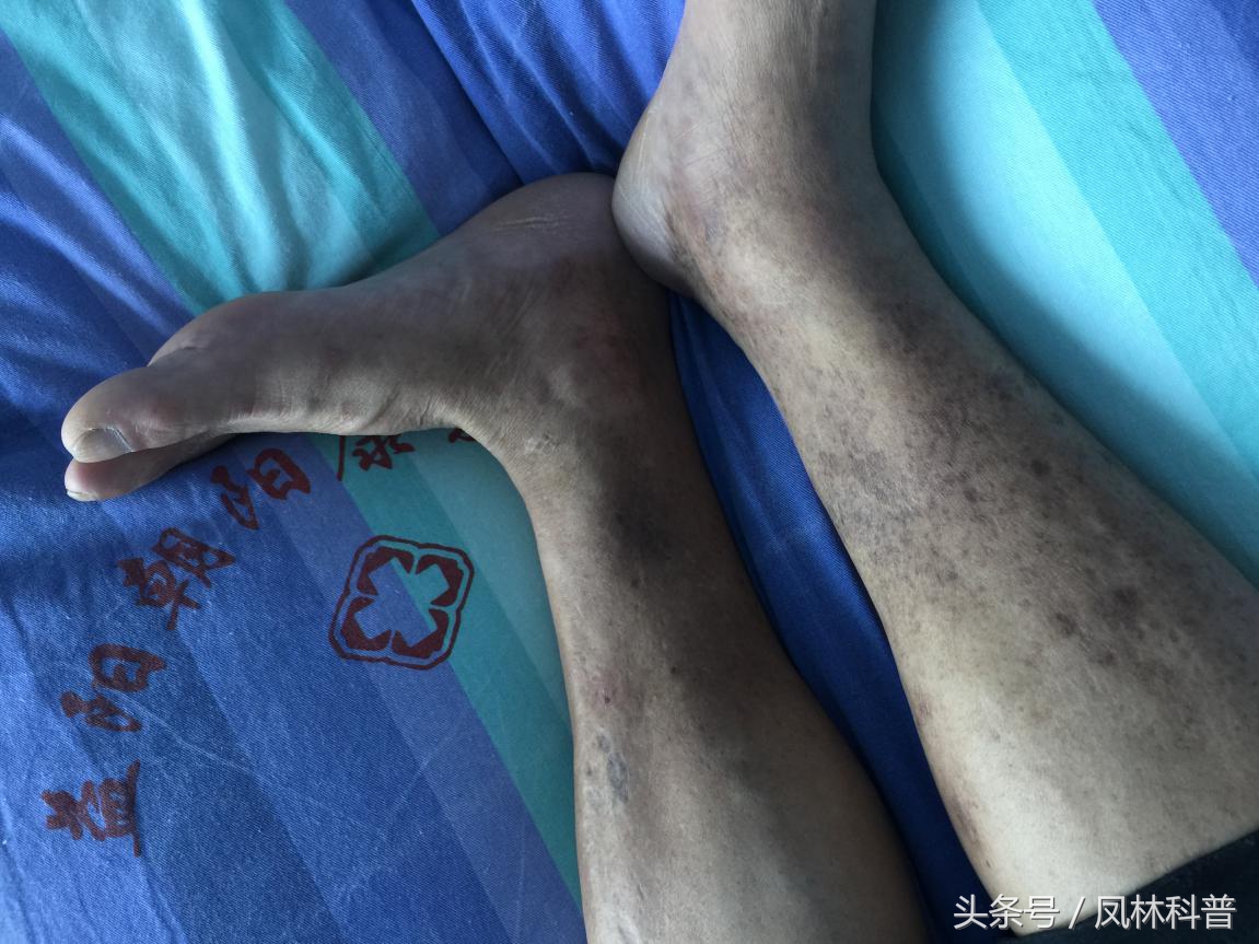 下肢静脉血栓的治疗及护理措施ppt,双下肢静脉血栓最佳治疗方法