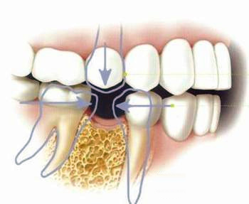 牙齿龋坏就剩牙根怎么处理,牙齿龋坏放任不管能坚持多久