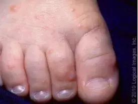 口腔疱疹发热怎么办,小孩发热口腔有疱疹