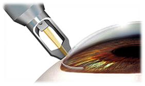 三岁宝宝散光怎么矫正,散光戴眼镜可以矫正吗