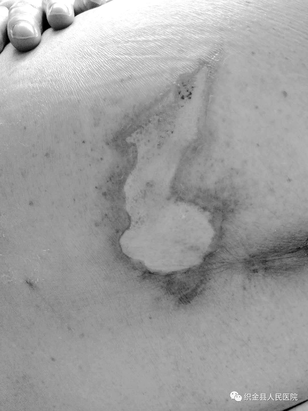 医患情深2019,伤口造口护理医患对话