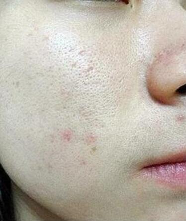 脸上毛孔粗大有坑怎么解决,脸上的毛孔又大又黑怎么处理