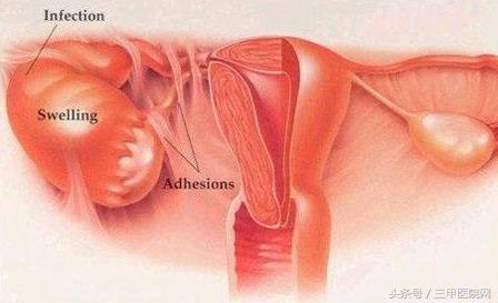 盆腔炎严重时会有宫外孕吗,盆腔炎症导致不孕