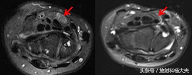 中年女性手麻手抖,女中老年人手麻是什么原因