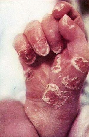 产检梅毒阴性是正常吗,孕妇产检梅毒阳性是怎么回事