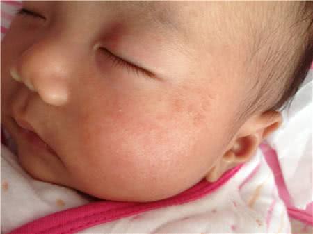 婴儿湿疹跟奶粉有关系吗,婴儿湿疹和奶粉过敏湿疹怎么区别