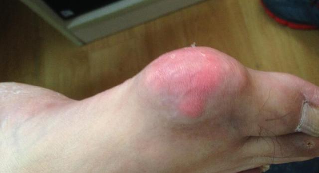 痛风和尿酸高可以吃哪几种菜,痛风吃什么菜可以降尿酸