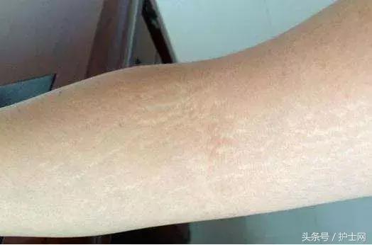 最近身体上出现的各种纹,身上竖着的纹是什么纹