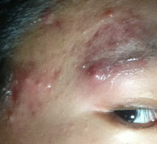 红蓝光祛痘可以永久祛痘吗,红蓝光祛痘印效果最好