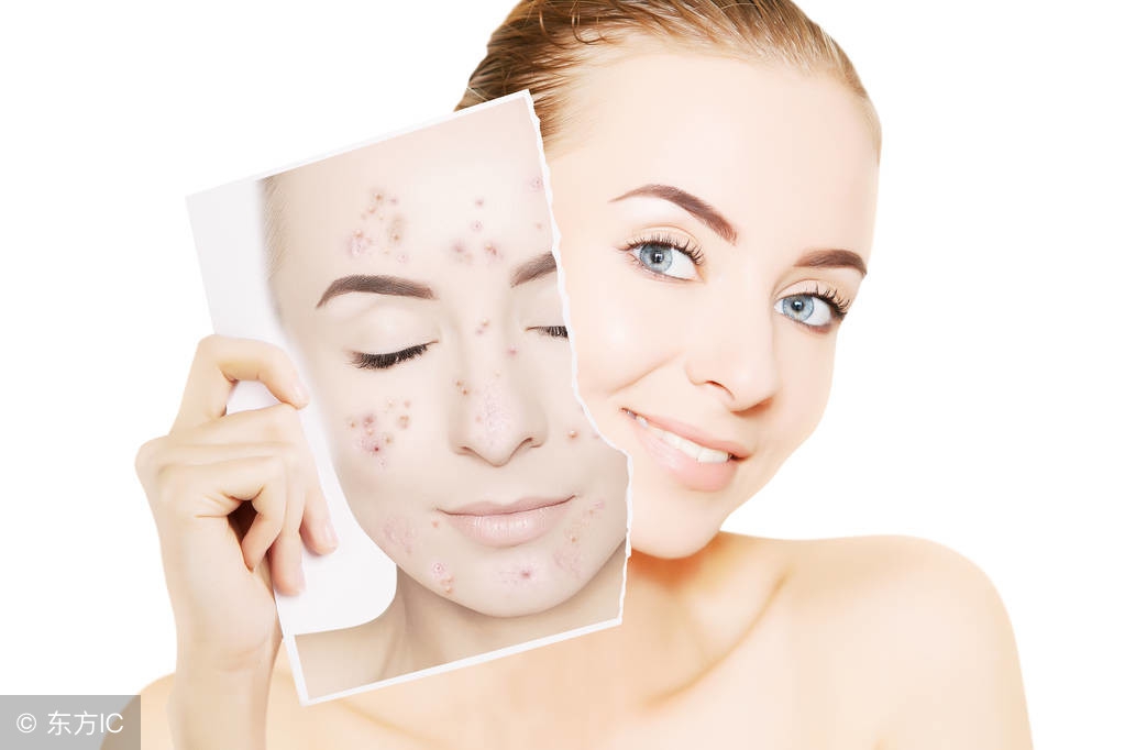 如何去除青春痘最快方法小妙招,怎么让青春痘快速去掉痘印