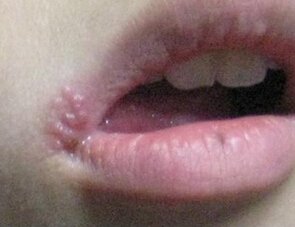 嘴角起泡可以用曲安奈德益康唑吗,上火嘴角起泡涂什么药膏快速消除