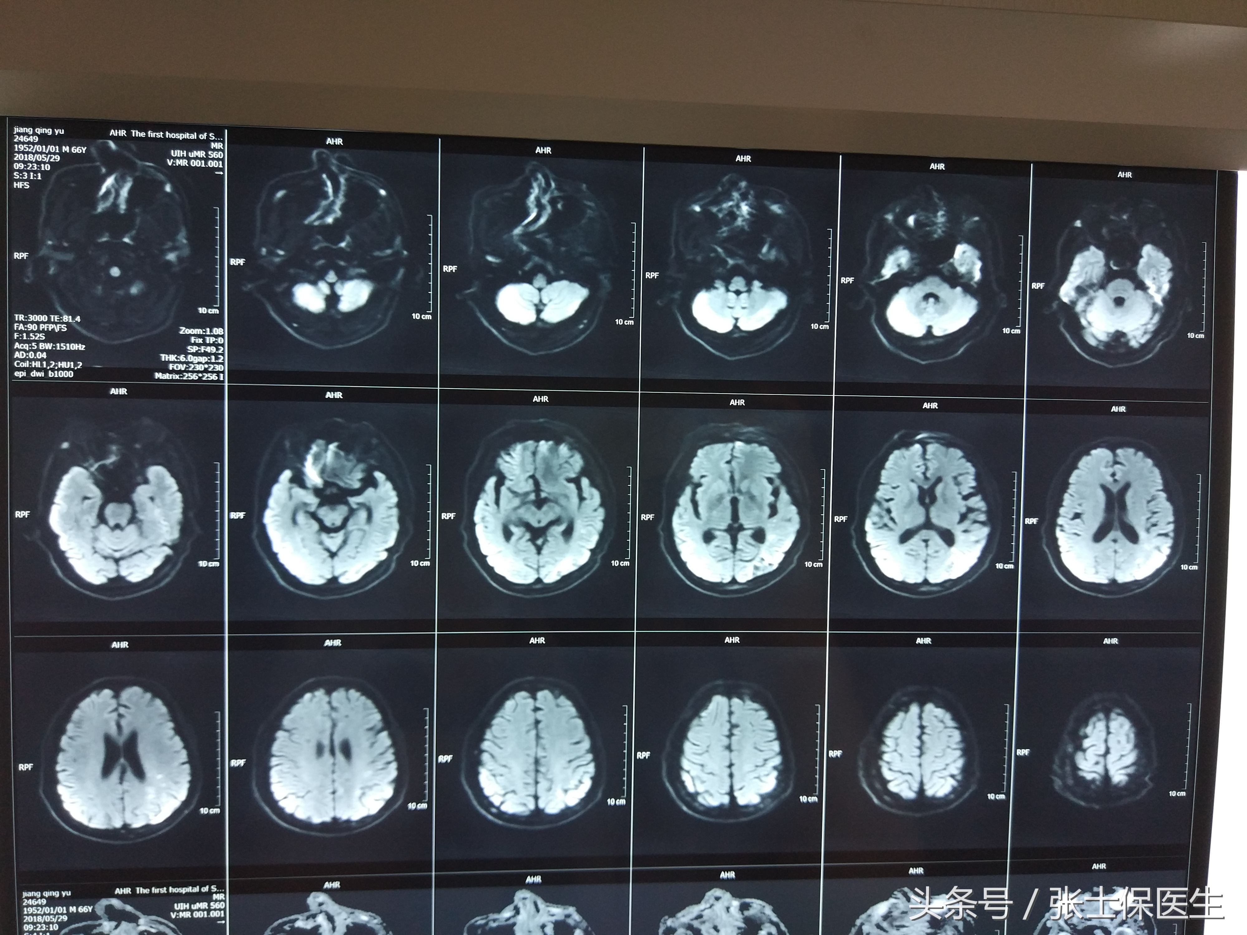 急性脑梗死会留后遗症吗,急性脑梗死要怎么康复