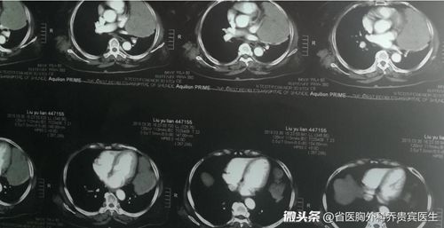 纵隔肿瘤切除后注意事项,纵隔肿瘤较大适合微创吗