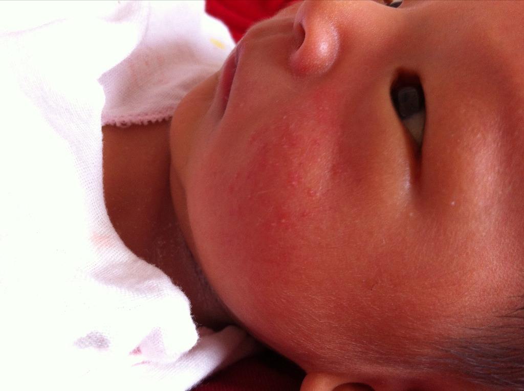 夏天湿疹最简单的自愈方法,夏天湿疹怎么治能去根