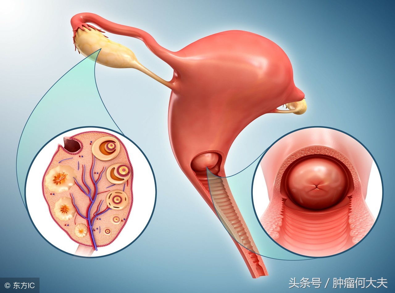 宫颈癌早期可以打宫颈癌疫苗吗,子宫癌和宫颈癌早期会发烧吗