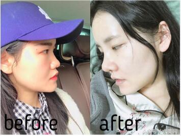 隆鼻后如何克服焦虑,隆鼻后前三天状态