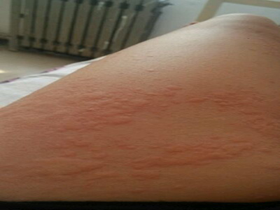 通宣理肺丸搭配什么中成药治麻疹,麻疹中医基本治疗原则是什么