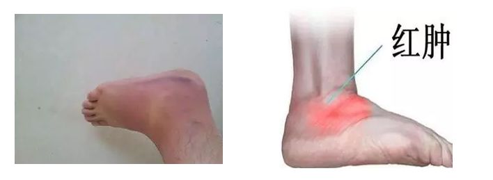 脚崴了用什么方法最有效,走路脚向外歪如何矫正