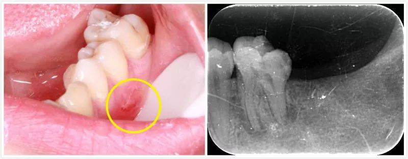 战痘多年才知道的真相,战痘多年不见效果