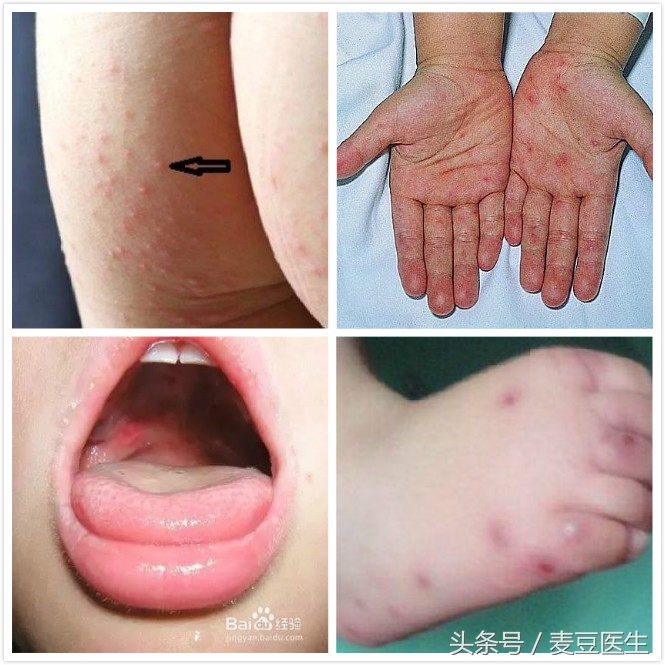孩子嘴里手心脚上出疹，发烧是怎么回事？带你全面认识手足口病