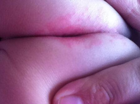 宝宝肛门周围发红，家长一定要采取正确的方式进行护理