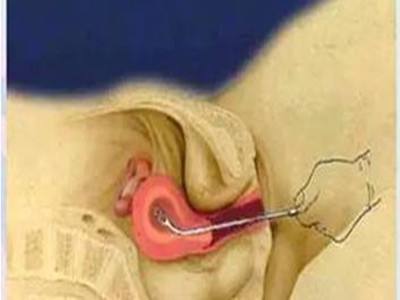 女性的一生可以承受几次流产?超过这个次数,身体就要毁了