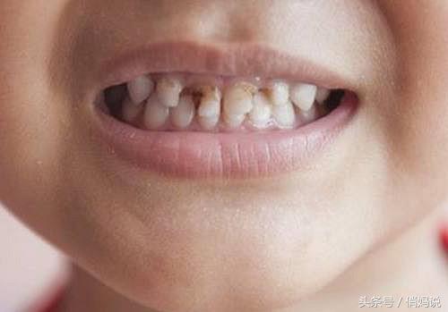 幼儿园为什么会有龋齿,小朋友为什么会有蛀牙幼儿园