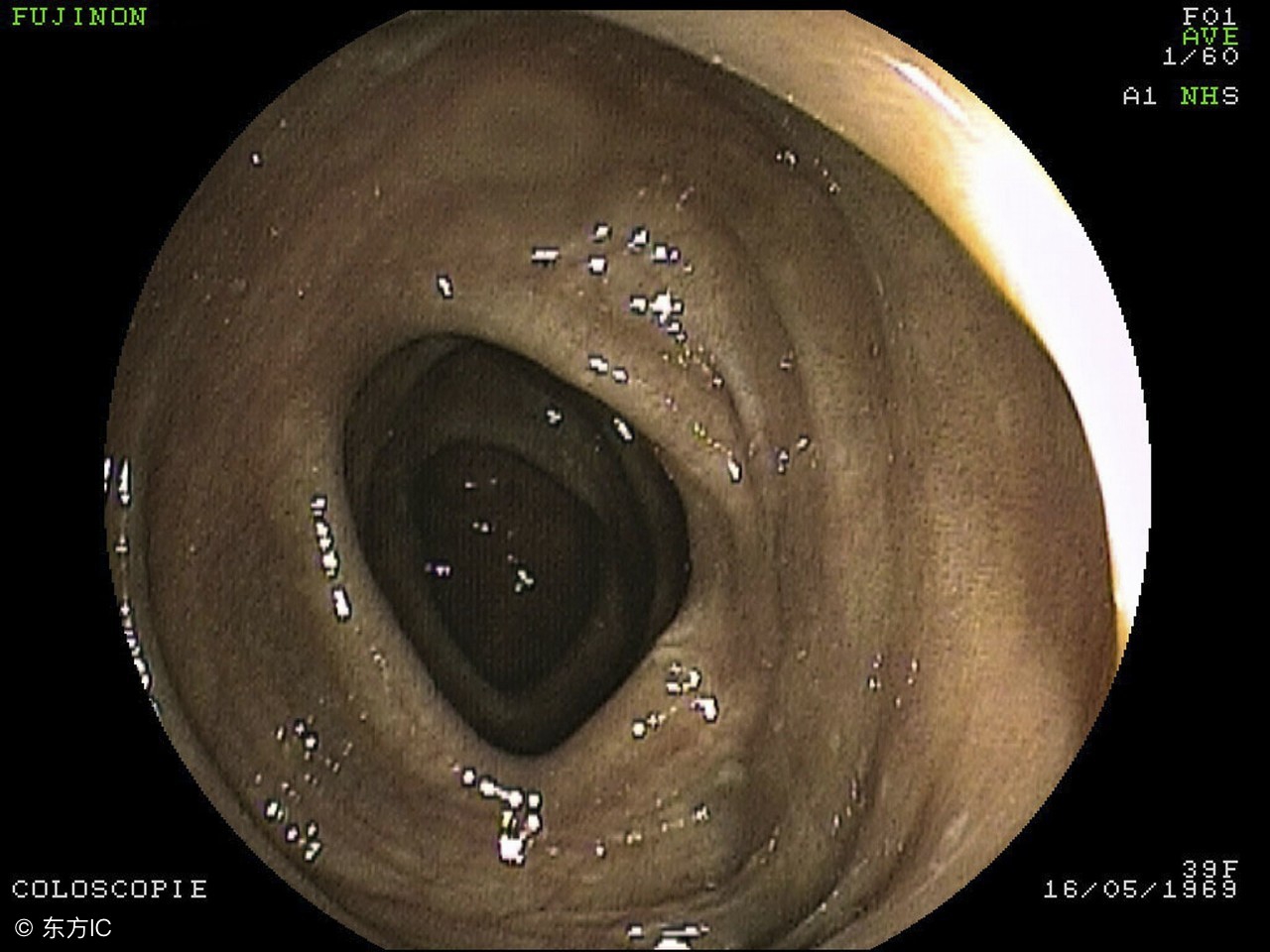 老人得结肠黑变病饮食怎么调理,结肠黑变是什么原因引起的