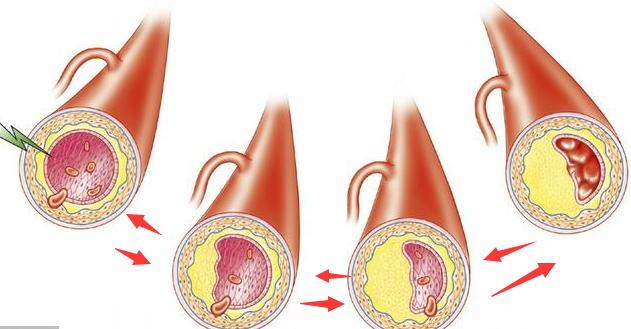 脑血栓和脑梗怎么彻底治疗,脑血栓和脑梗能治好吗