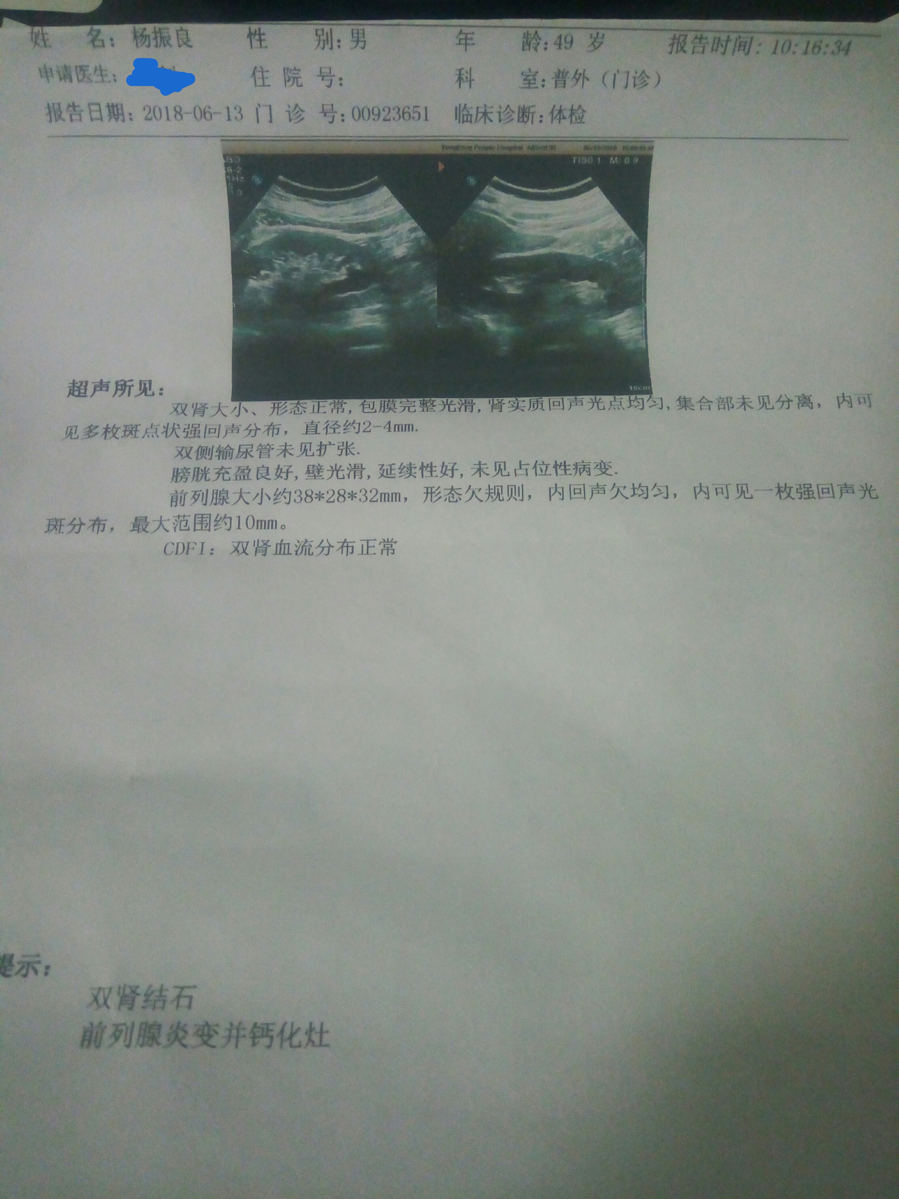 尿道结石微创术,尿道结石的微创手术全过程