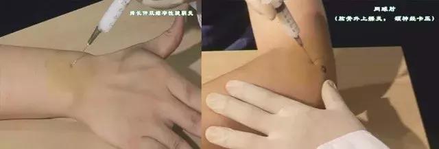 关于封闭疗法的知识,封闭治疗到底好不好